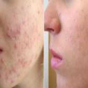 Kozmetika za obraz akne