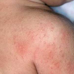 Alergija kože: vzroki, simptomi, zdravljenje