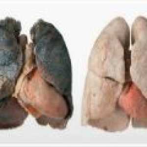 Zdravljenje bronhitis kadilca