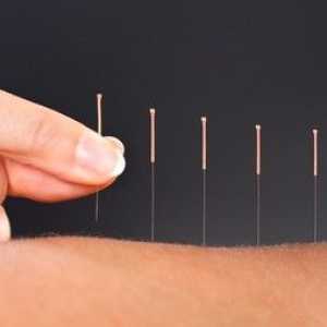 Akupunktura: Resnice in miti