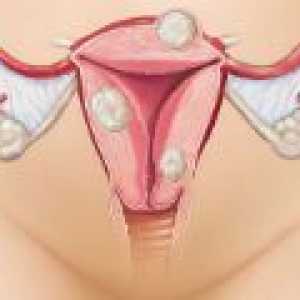 Zdravljenje maternice fibroids brez operacije