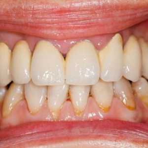 Zdravljenje parodontalne ljudskih bolezni pravna sredstva: najbolj učinkovite metode