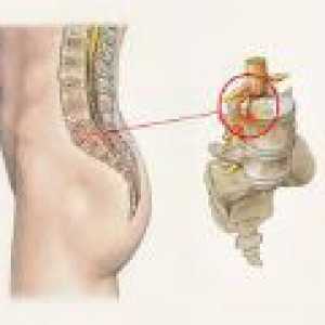 Zdravljenje izboklino ledvene hrbtenice