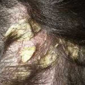 Seborrhea lasišča Zdravljenje