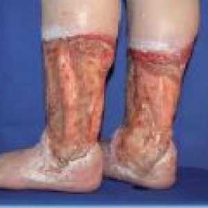 Zdravljenje razjed venskih nog