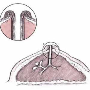 Melanom na bradavico: diagnoza in zdravljenje