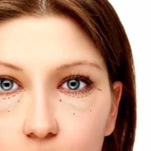 Vrečke pod očmi: Vzroki in Zdravljenje