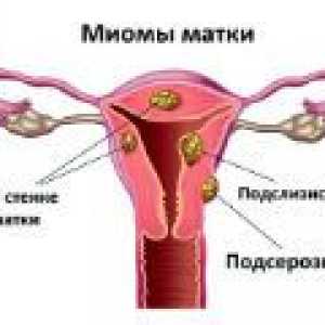 Več fibroidi - vzroki, simptomi, zdravljenje