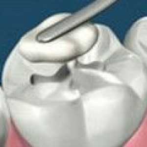 Nenavadne materiale za tesnila bo boj proti zobni gnilobi