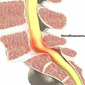Nestabilnost simptomov vratne hrbtenice in zdravljenje
