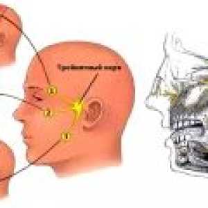 Nevralgijo obraznega živca: simptomi, zdravljenje