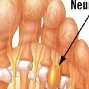 Mortonov neurom (boleče stopalo) - vzroki, simptomi in zdravljenje