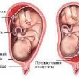 Nizka Placentacija med nosečnostjo, kaj je to?