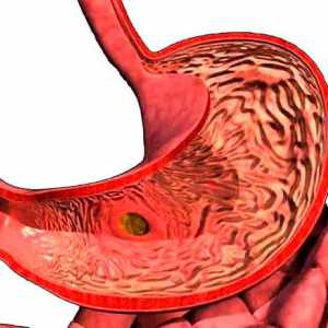 Poslabšanje gastritis: simptomi