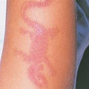 Lastnosti alergijske manifestacije dermatitis