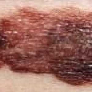 Značilnosti in zdravljenje razširjenih oblik melanoma