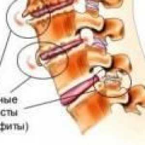 Osteofiti iz vratne hrbtenice: vzroki, zdravljenje