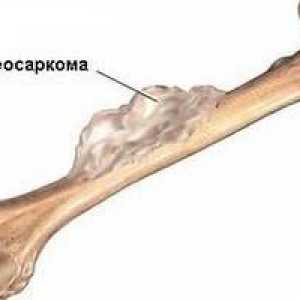 Osteosarkom (osteogeni sarkom) - vzroki, simptomi, diagnosticiranje in zdravljenje