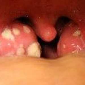 Peritonsillar absces: simptomi, zdravljenje