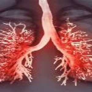 Plevritis pljuča - simptomi in zdravljenje z plevritisa