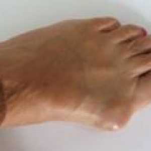 Cross flatfoot: simptomi, zdravljenje