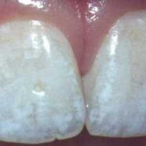 Vzroki za bele lise na zobeh
