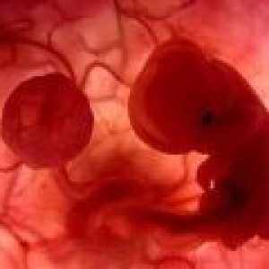 Vzroki za spontani splav v zgodnji nosečnosti