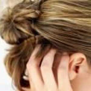 Akne na čelu - kako se znebiti od njih?
