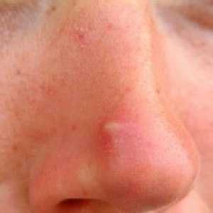 Mozolji na nosu: vzrokih, zdravljenju in preprečevanju