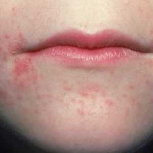 Akne okrog ust: kako se znebiti od njih
