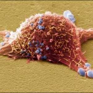Rak kože: Vrste, Simptomi, metode zdravljenja
