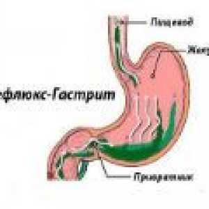 Povratni gastritis: Vzroki, simptomi, zdravljenje
