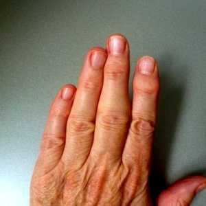 Revmatoidni artritis prstov, prvi simptomi