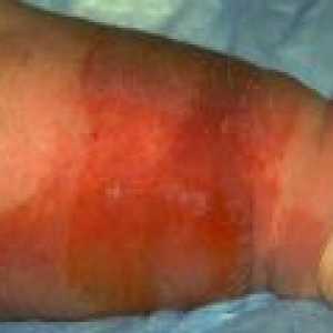 Rdečica spodnji del noge: diagnoza in zdravljenje