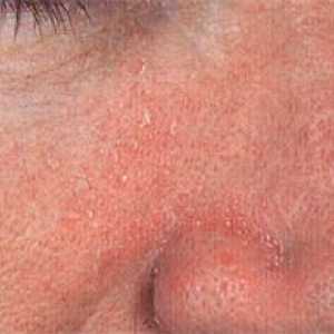 Seboroični dermatitis (ekcem mastna) obraza: vzroki, zdravljenje in preprečevanje