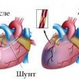 Heart bypass kirurgija plovila (koronarnih arterij bypass cepljenje)