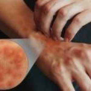 Simptomi in zdravljenje atopijskega dermatitisa