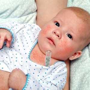 Simptomi in zdravljenje škrlatinke pri otrocih