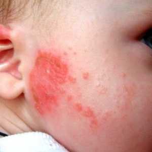 Simptomi in zdravljenje škrlatinke pri otrocih