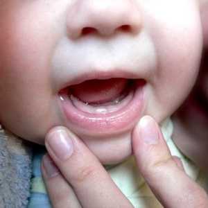 Simptomi zob pri dojenčkih