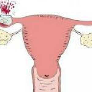 Simptomi zunajmaternične nosečnosti v zgodnji nosečnosti