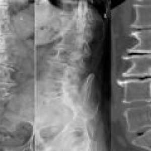 Spondilartroze ledvene hrbtenice