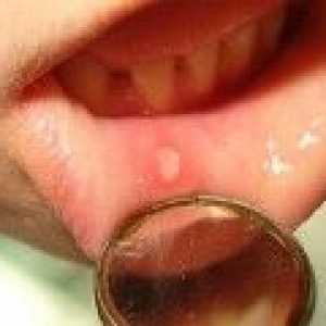 Stomatitis pri odraslih: kaj in kako ravnati stomatitis v ustih?