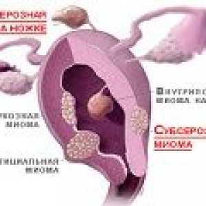 Subserous fibroidi - vzroki, simptomi, zdravljenje