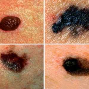 Vrste melanomov in njihovo klasifikacijo