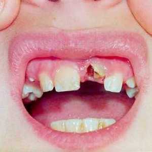 Zobni travma