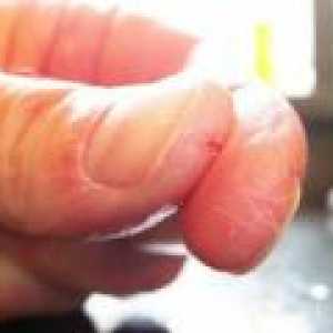 Razpokana koža na rokah - vzroki, zdravljenje