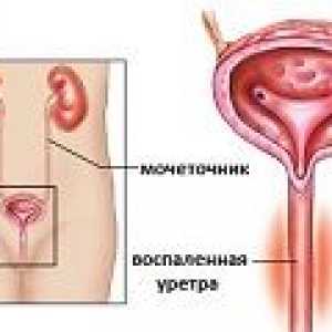 Uretritis pri ženskah - vzroki, simptomi, zdravljenje
