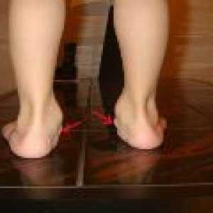 Valgus ploska stopala pri otrocih: Vzroki in zdravljenje
