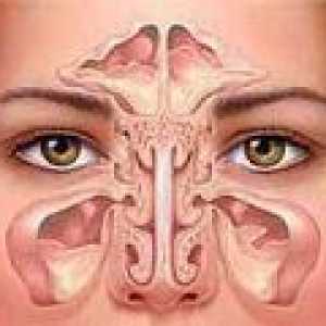 Maksilarni sinuzitis: akutna in kronična